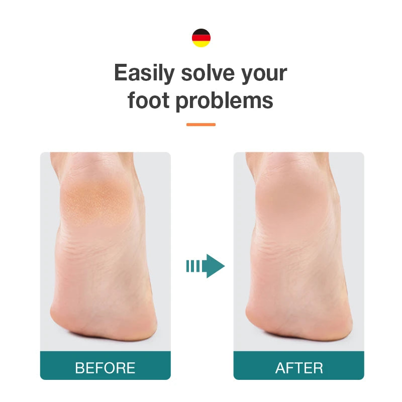 MR.GREEN Double Sided Foot File Callus Remover For Pedicure